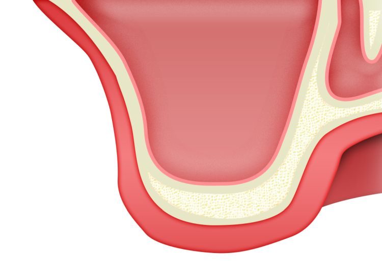 ip-sinus-grafting-kit_slajdy_dostep_boczny_0000_init