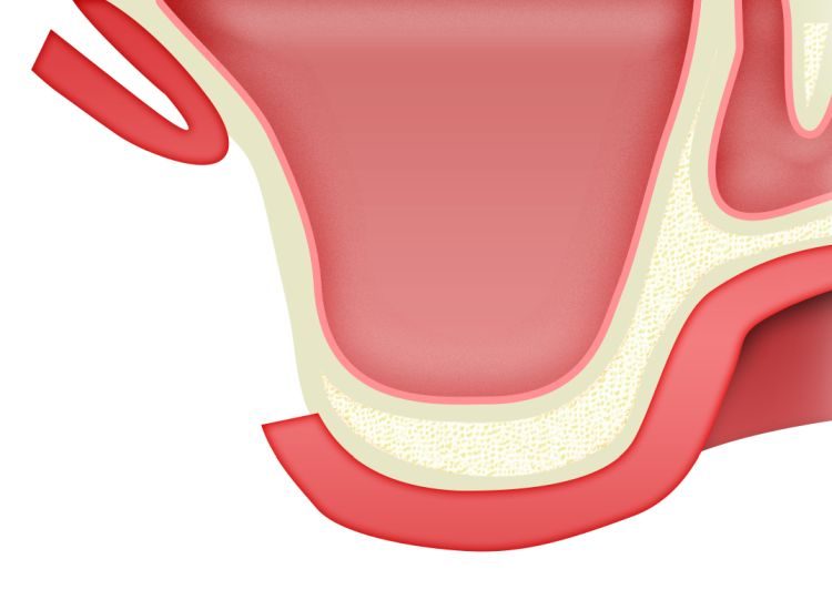 ip-sinus-grafting-kit_slajdy_dostep_boczny_0001_cut