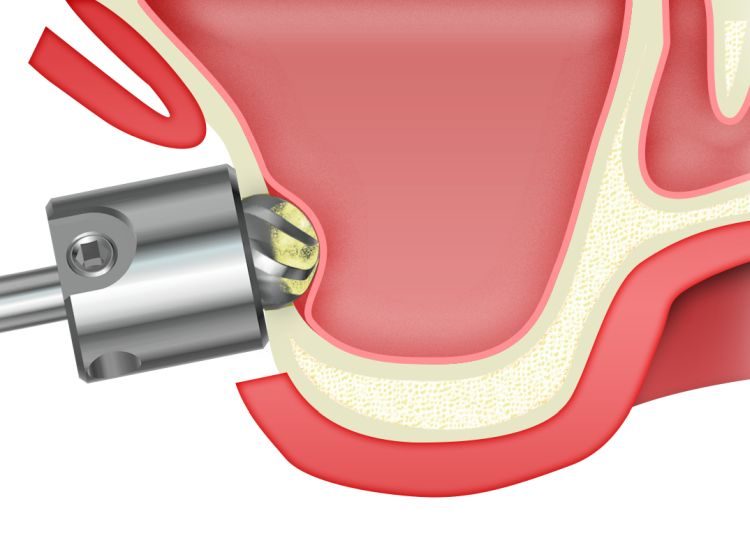 ip-sinus-grafting-kit_slajdy_dostep_boczny_0002_frezowanie