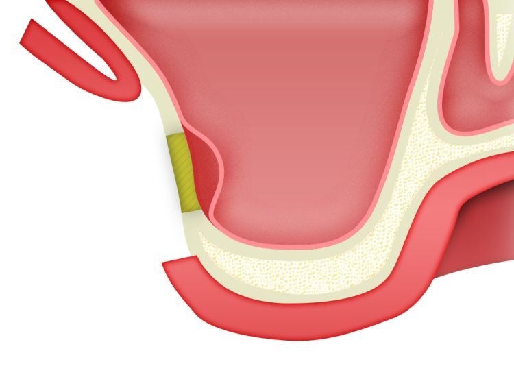 ip-sinus-grafting-kit_slajdy_dostep_boczny_0003_frezowanie-po