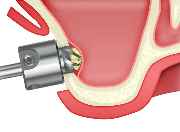 ip-sinus-grafting-kit_slajdy_dostep_boczny_0004_frezownie-gruba-sciana