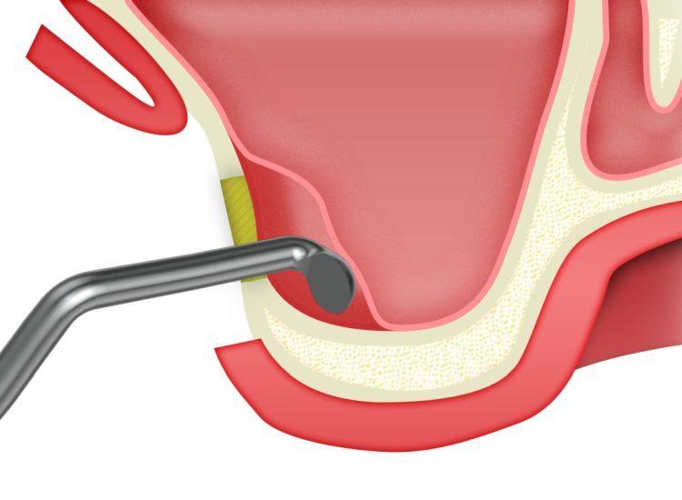 ip-sinus-grafting-kit_slajdy_dostep_boczny_0005_elevator-1