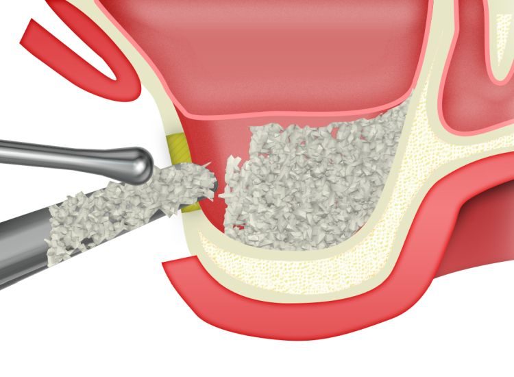 ip-sinus-grafting-kit_slajdy_dostep_boczny_0007_elevator-3-gruz