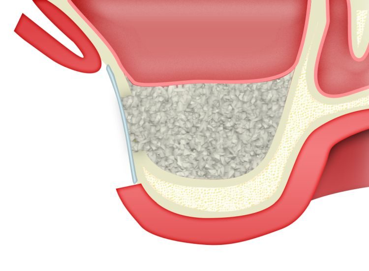 ip-sinus-grafting-kit_slajdy_dostep_boczny_0008_gruz