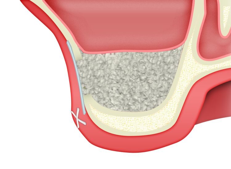 ip-sinus-grafting-kit_slajdy_dostep_boczny_0009_zamkniecie