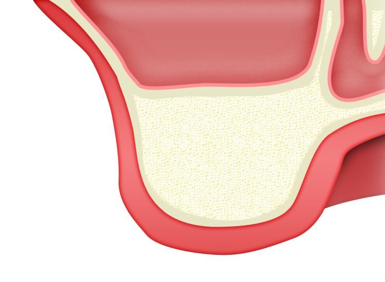 ip-sinus-grafting-kit_slajdy_dostep_boczny_0010_finish